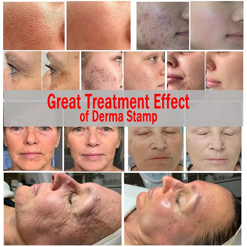 Derma Selo Agulhas Minha loja